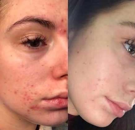 Nu Skin AHA Facial Peel and Neutraliser