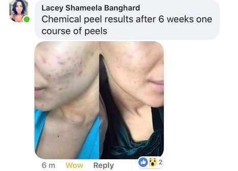 Nu Skin AHA Facial Peel and Neutraliser