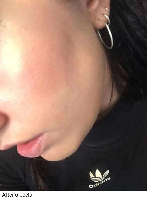 Nu Skin AHA Facial Peel and Neutraliser