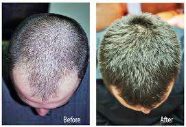 272 Diode Laser Hair Restoration Cap