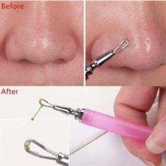 2x Blackhead Acne Blemish Tool remover-