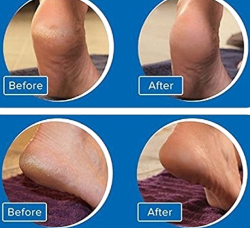 Ultimate Pedi - DermaWand (Please Read)