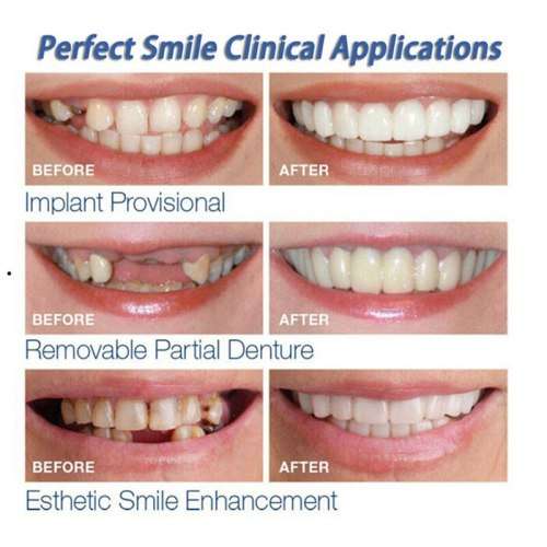Instant Snap On Perfect Smile Veneers