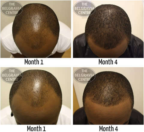 Brilliant and Potent Quick Grow and Anti - Hair Loss Horse Hair Shampoo Treatment