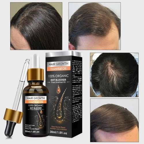 Incredible PEI MEI BIOTIN RAPID HAIR GROWTH and ANTI HAIR LOSS ESSENTIAL OIL
