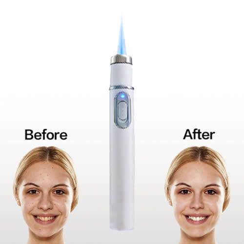 Blue Light Acne, Acne Scars ,Unsightly Veins , Pimples Removal and Repair Laser Therapy Pen