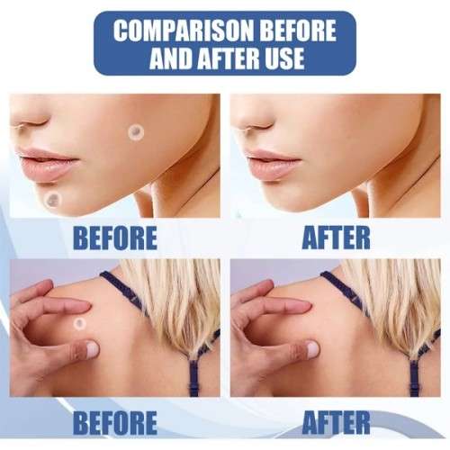 Brilliant & Effective Full Body Skin Tag , Mole & Wart Removal Patches  ( 144 Pcs )