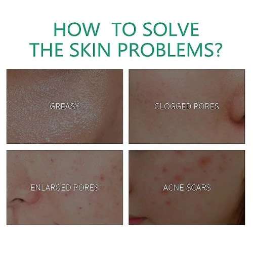 AC Anti Fungal Acne , Acne Scar & Pimple Removal Cream