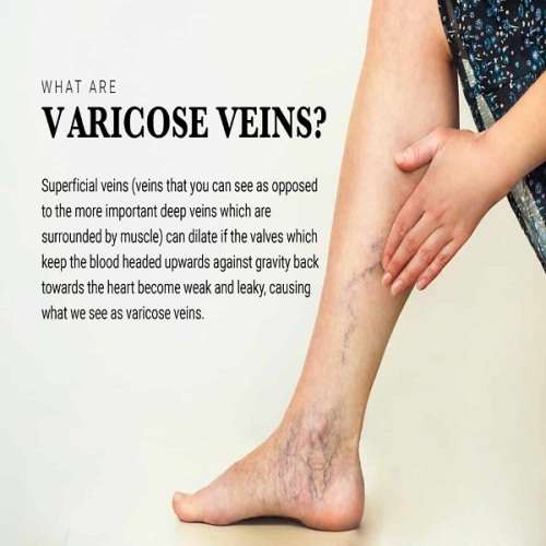 Instant Relief & Highly Effective Varicose Veins Patch
