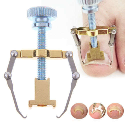 Ingrown Toenail Correction Tool
