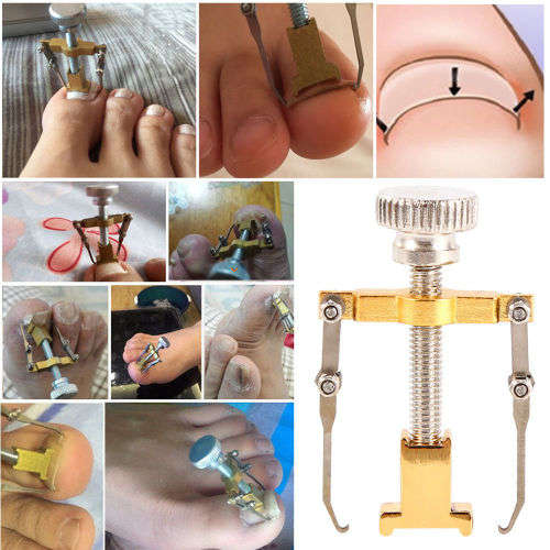 Ingrown Toenail Correction Tool