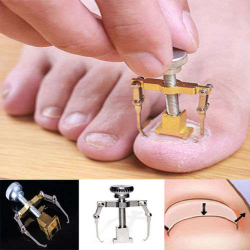 Ingrown Toenail Correction Tool