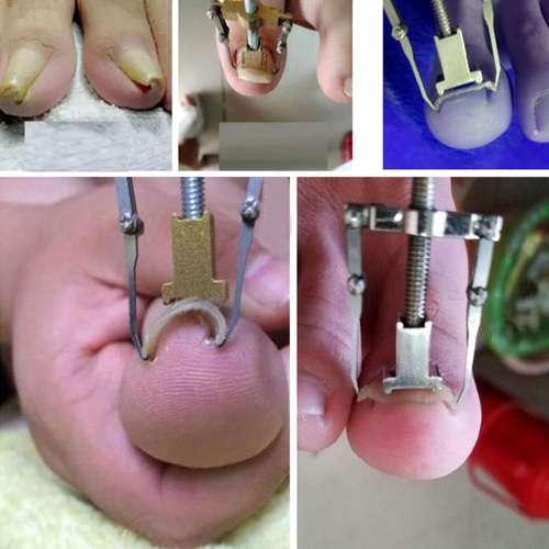 Ingrown Toenail Correction Tool