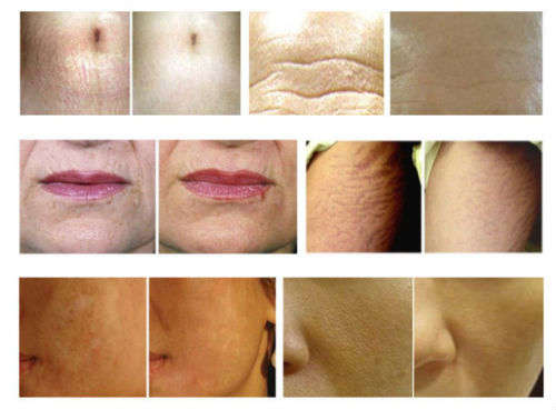 540 DermaRoller for Face 1.5mm for Cellulite, Anti-Aging, Acne Removal and Refines Pores