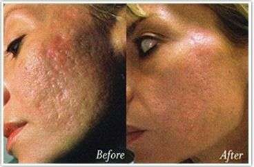 540 DermaRoller for Face 1.5mm for Cellulite, Anti-Aging, Acne Removal and Refines Pores