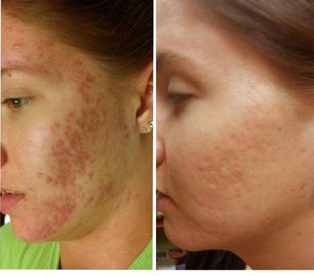 540 DermaRoller for Face 1.5mm for Cellulite, Anti-Aging, Acne Removal and Refines Pores