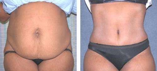 NOMOREFAT 5 week program by Javanti Wrap Lose up to 25cm in 1Hour!! no jokes! Bid now and save