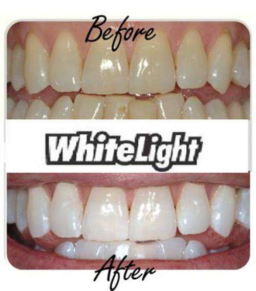 LASER LIGHT Home Teeth Whitening System within 10 minutes