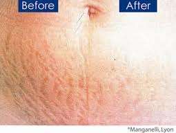 Strech marks remover cream