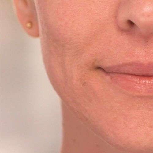 Flawless Facial Hair Remover