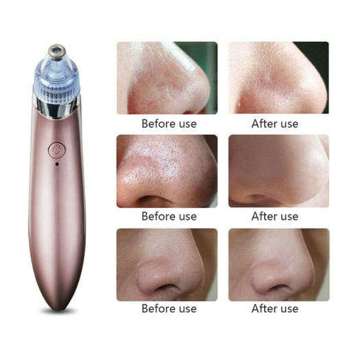 Electric Facial Cleaner Blackhead Vacum Meter Nose Pore Acne Suction Remover!