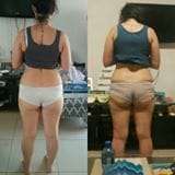 Lipo Cellulite Busting Injections