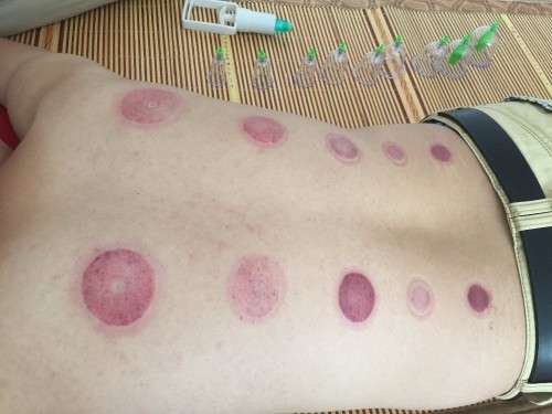 12 Cups Chinese Pull Out Vacuum Cupping Apparatus Therapy Body Massage Pump