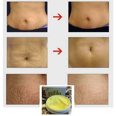 BUY 2 X PASJEL SCAR AND STRETCH MARK CREAM AND GET A CORSET BODYSHAPER WAIST TRAINER WORTH R200 FREE