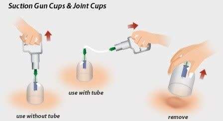 HOME CUPPING SET