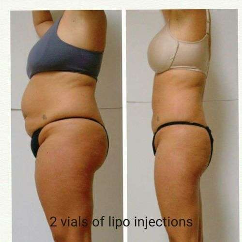 * SPECIAL - Lipotropic Slimming Injections - 40's