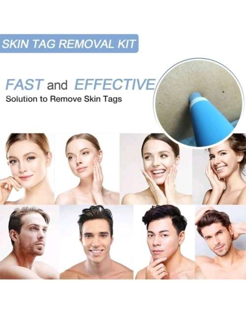 Skin Tag Remover Kit - THAT WORKS!