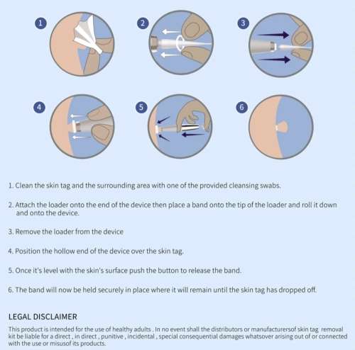 Skin Tag Remover Kit - THAT WORKS!