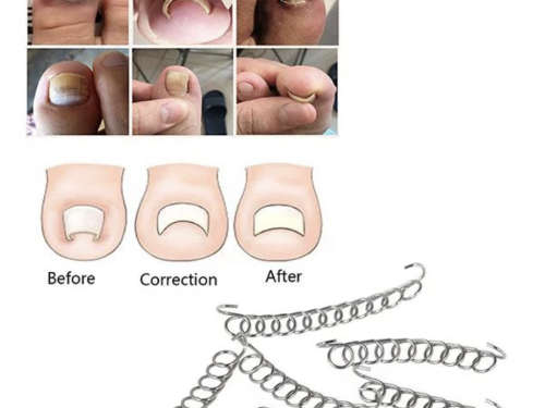 Ingrown Toenail Correction Wire Fixer Tool - 6 Pieces/Box