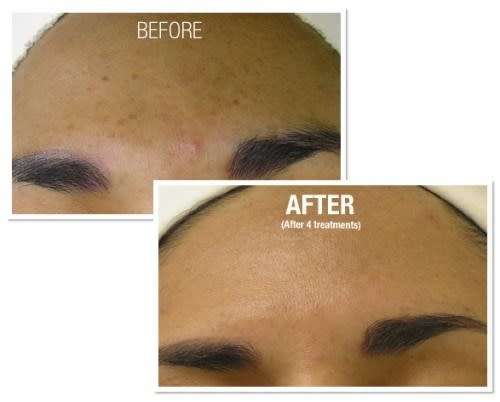 Most professional & powerful 540 needle derma-roller system