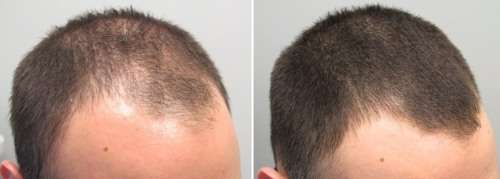 TrichoMed Minoxidil Spray 5% For Hair Loss - 60ml (3 Month Supply)