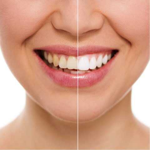 20 MINUTE DENTAL TEETH WHITENING KIT