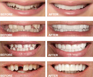 Snap on Smile Teeth veneers