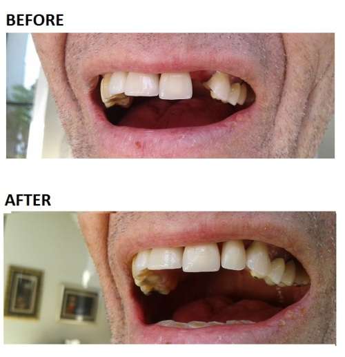FIX-YOUR-SMILE - D.I.Y. temp replacement tooth 5g