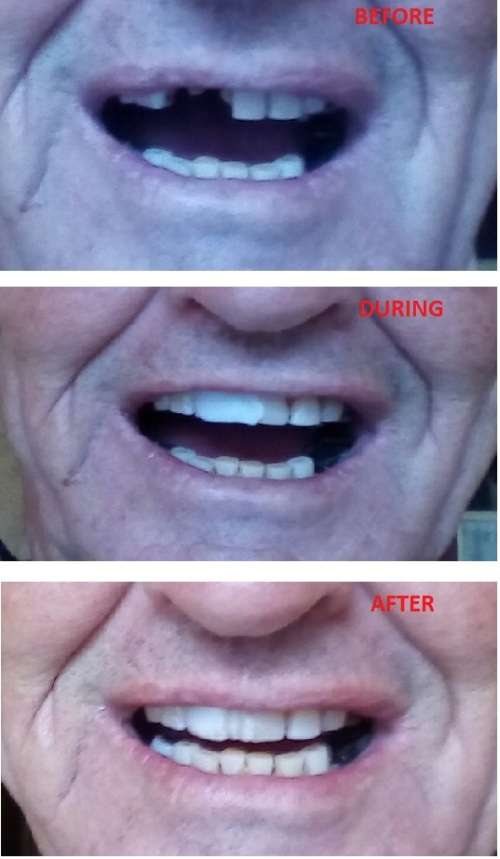 FIX-YOUR-SMILE - D.I.Y. temp replacement tooth 5g