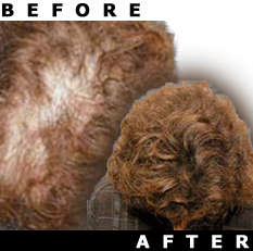 PHOTENZA Laser Wand for Hair Loss, Acne, Pain, Burns, Scars, Wrinkles, etc.