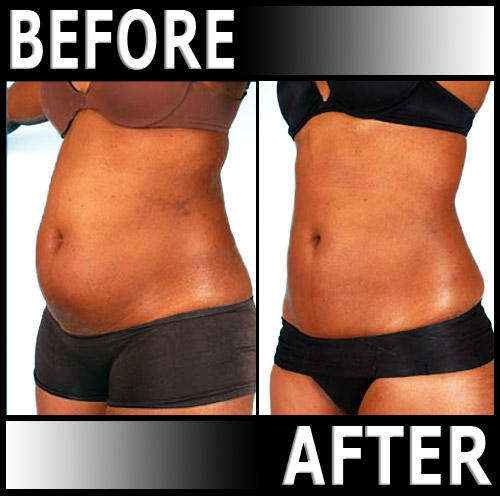 LASER SLIMMING Machine - Photenza LASER LIPO - Lose inches in minutes!
