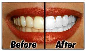 Dentist teeth whitening diy kit for whiter teeth
