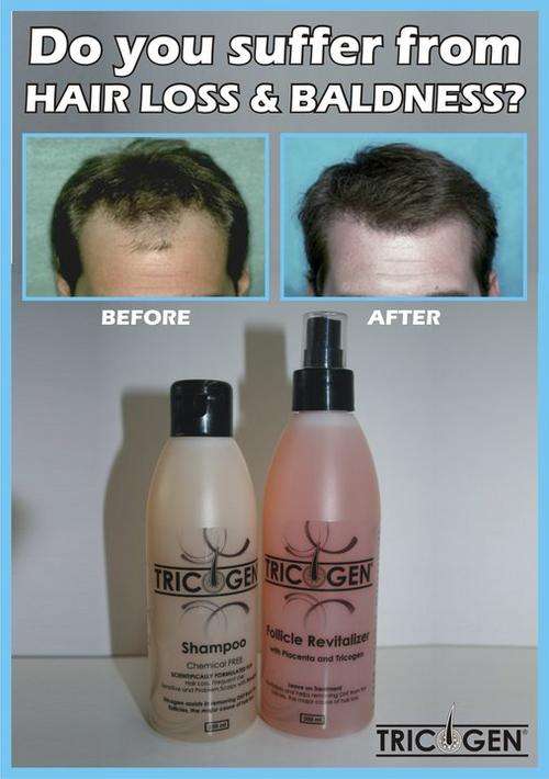 Tricogen Hair Loss Treatment