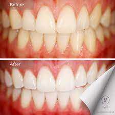 *LATE ENTRY*DOUBLE COMBO DEAL*MY SMILE TEETH WHITENING KIT*2 X WHITENING PENS, 2 X CHARCOAL POWDER*