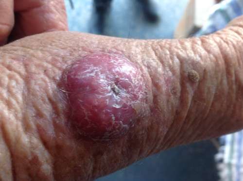 Cancer saved by Xango