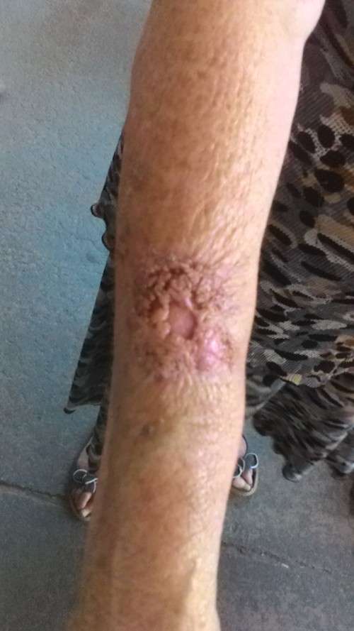 Cancer saved by Xango