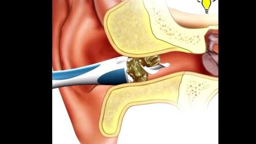 Smart Swab Easy Earwax Removal